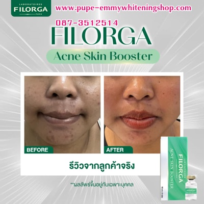 ٻҾ2 ͧԹ : Meso ˹Ң FILORGA ACNE SKINBOOSTER       ѡʺ شѹ Ҩ˹  ˹ҢǵӤá