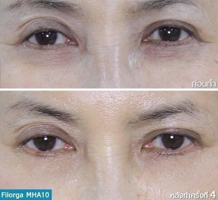 ٻҾ4 ͧԹ : FILORGA MHA 10Ŵ͹Фͧͺǧ   һ (Mesotherapy)ҪԴ仺ǳ˹ѧ п鹿٤ͧǧШҧ觢