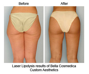 ٻҾ5 ͧԹ : Lipo Lab ѭ,,鹢˭,اѡ,ᢹ˭, 繼ŷѹ Ҵ